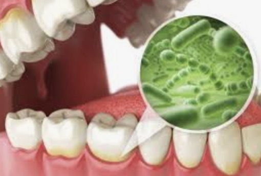 Oral Infections